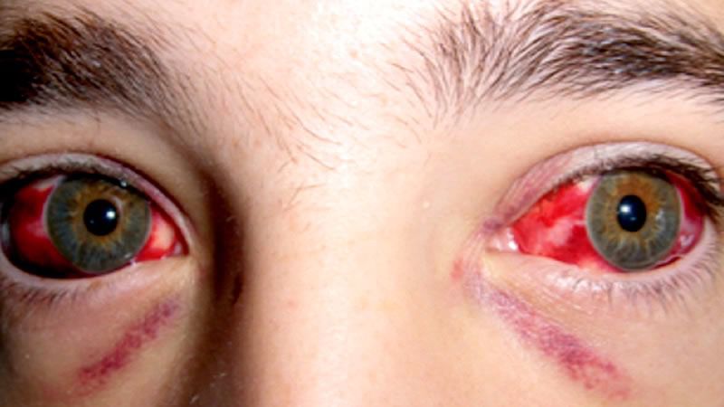 Salud alertó por el aumento estacional de casos de Fiebre Hemorrágica Argentina y recordó las medidas de prevención